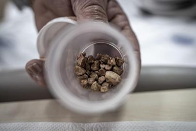 İdrar kanalından 51 taş çıkarıldı