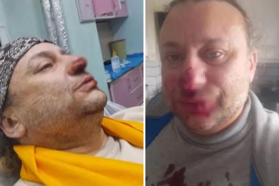 Onur Akay, başıboş pitbull köpeğinin saldırısında yaralandı